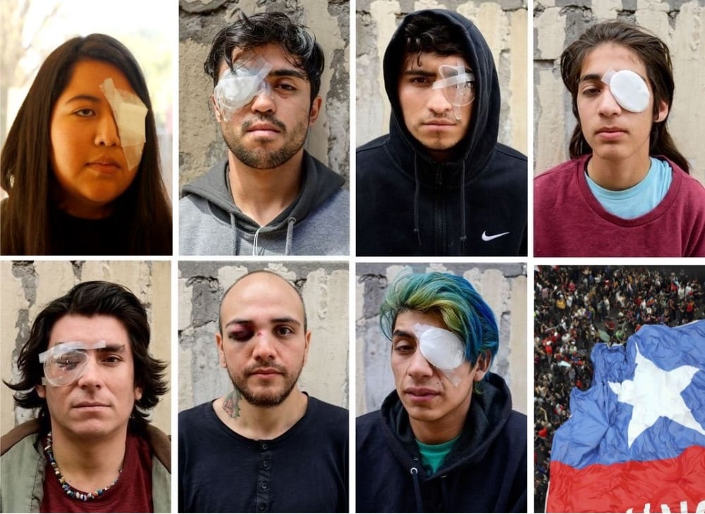 Manifestantes Con Daño Ocular Piden Justicia En Chile